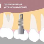 Имплантация зубов в Москве: путь к идеальной улыбке